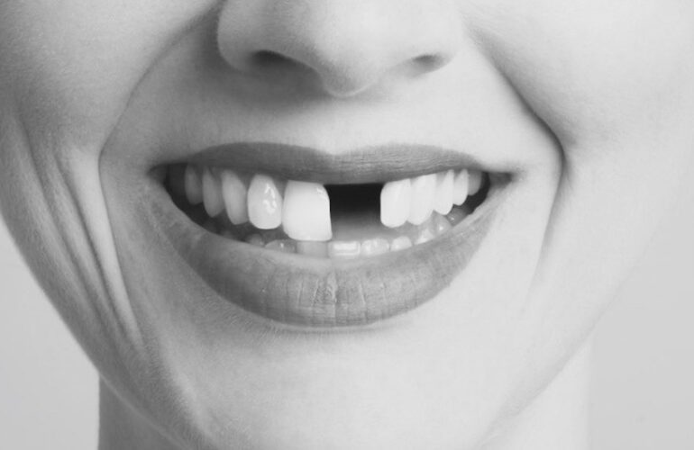 Quick Fix for Tooth Loss
