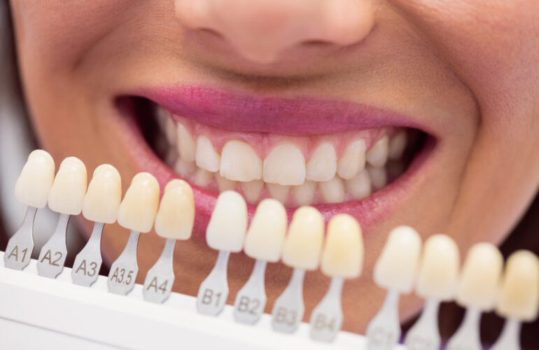 Teeth Whitening Maintenance Tips